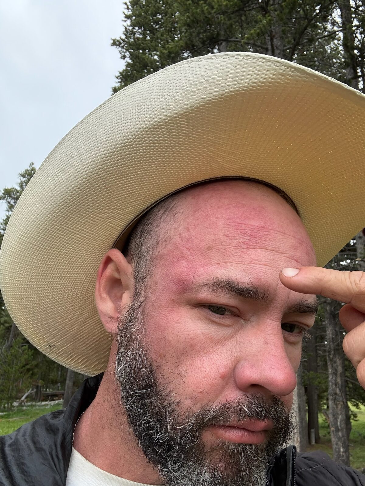 Mark pointing at the mosquito bites on his forehead